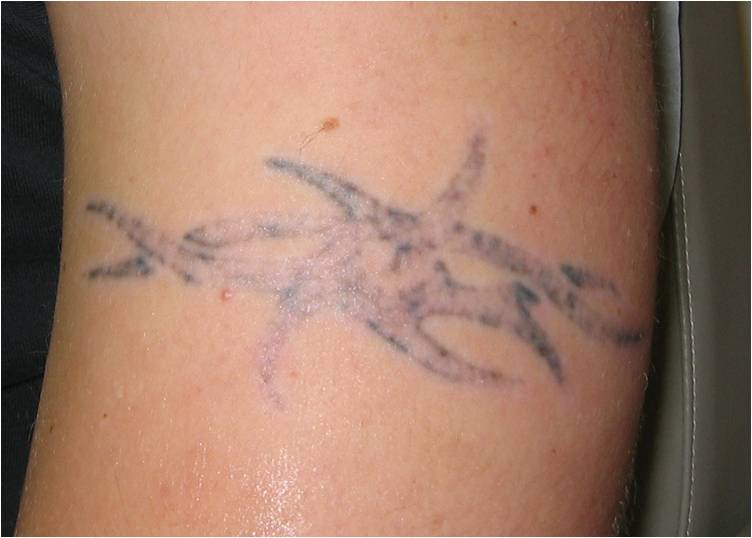Tattoo Removal